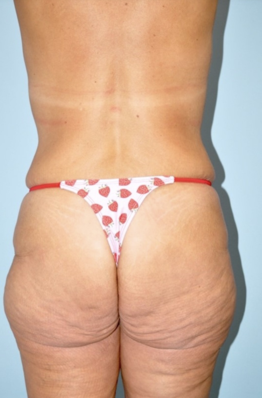 Patient Lower Body Lift Before 4