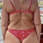 Patient Lower Body Lift Thumbnail Before 6