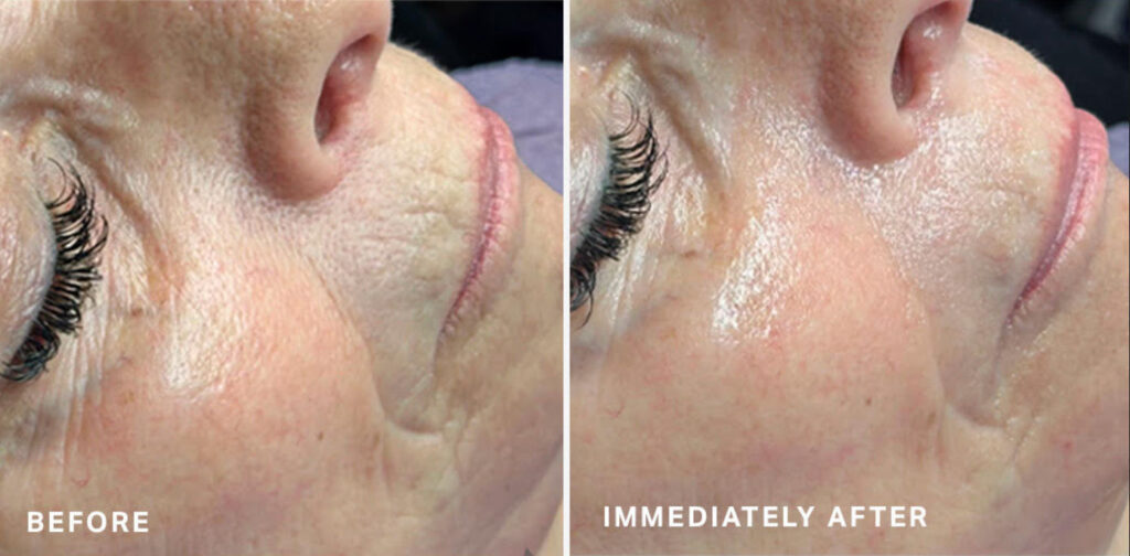 Hydrafacial™ Patient