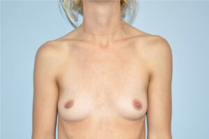 Patient Breast Augmentation Before 0