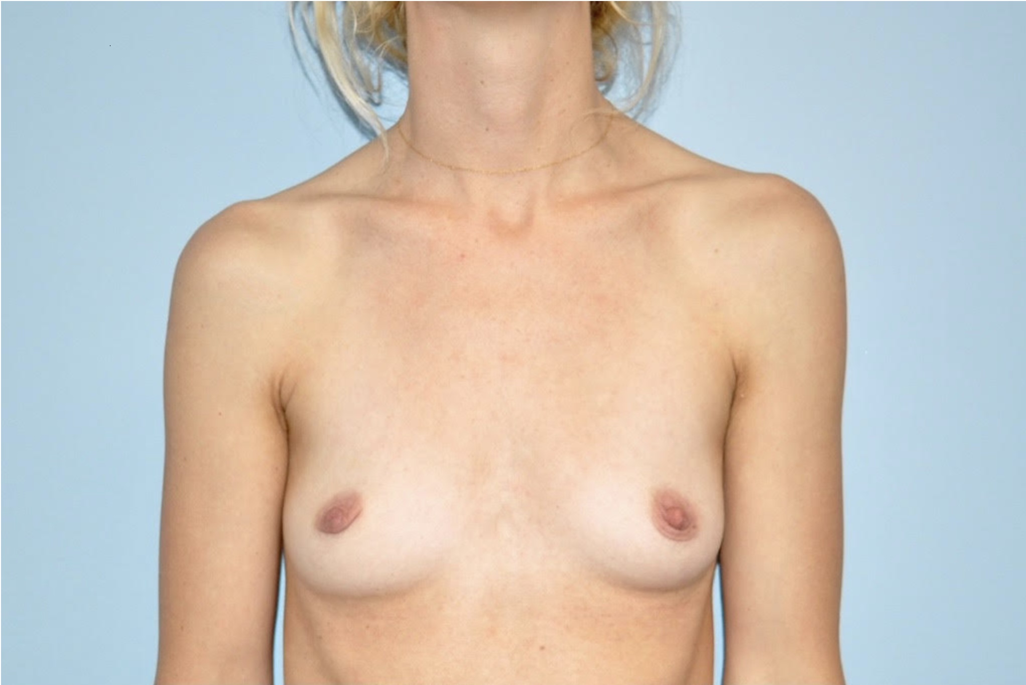 Patient Breast Augmentation Before 0