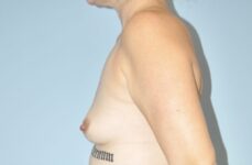 Patient Breast Augmentation Thumbnail Before 2