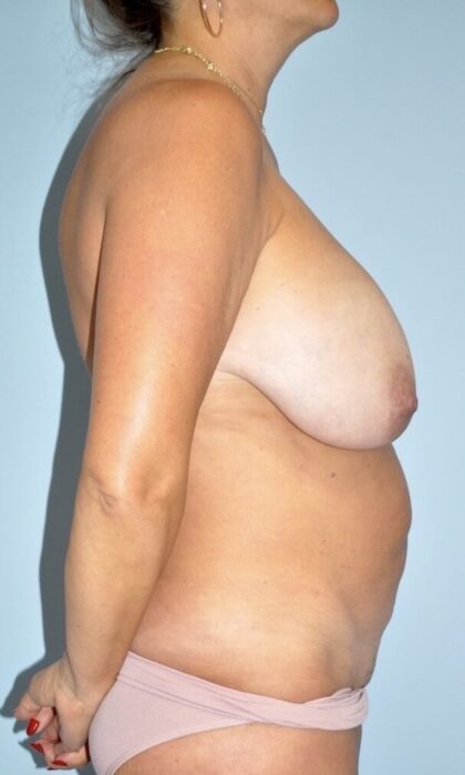 Patient Mommy Makeover Before 2