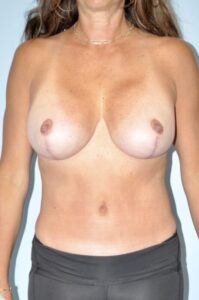 Patient Mommy Makeover After 0