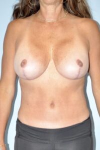 Patient Tummy Tuck After 0