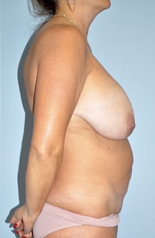 Patient Tummy Tuck Before 2