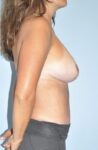 Patient Tummy Tuck Thumbnail After 2