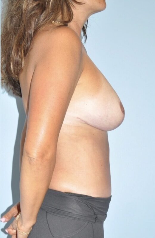 Patient Tummy Tuck Before 2