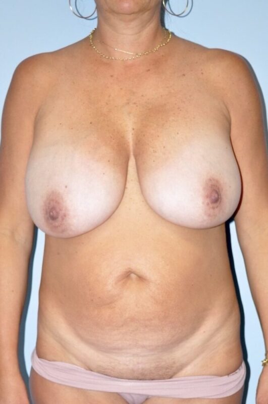Patient Tummy Tuck Before 0