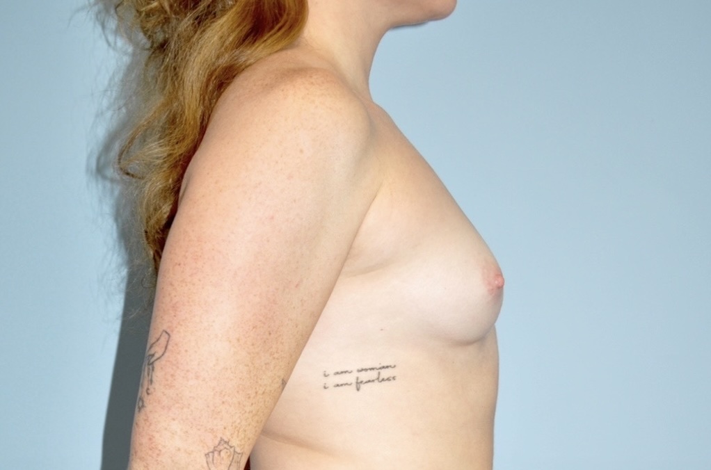 Patient Breast Augmentation Before 2