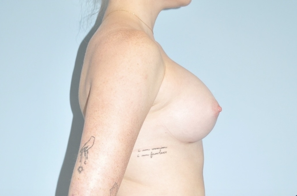 Patient Breast Augmentation Before 2