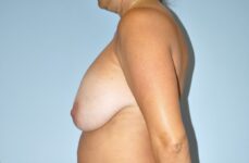 Patient Breast Implant Revision Thumbnail Before 2