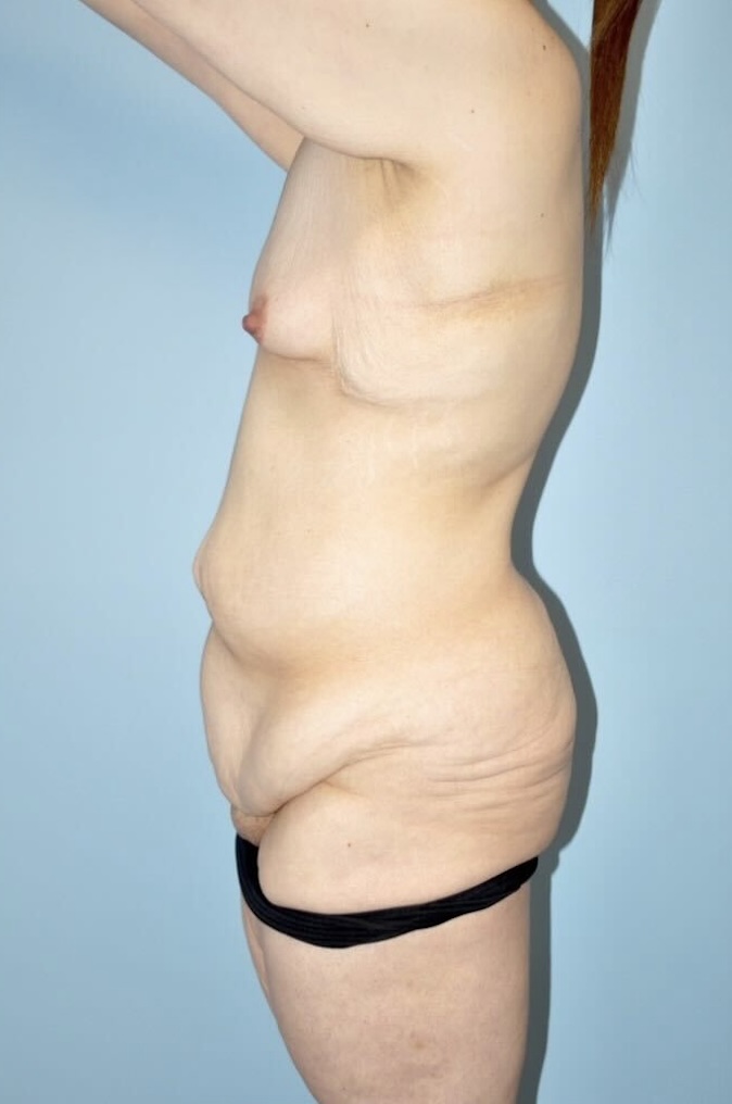 Patient Lower Body Lift Before 2