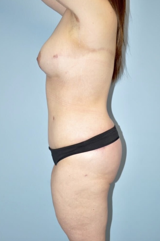 Patient Lower Body Lift Before 2