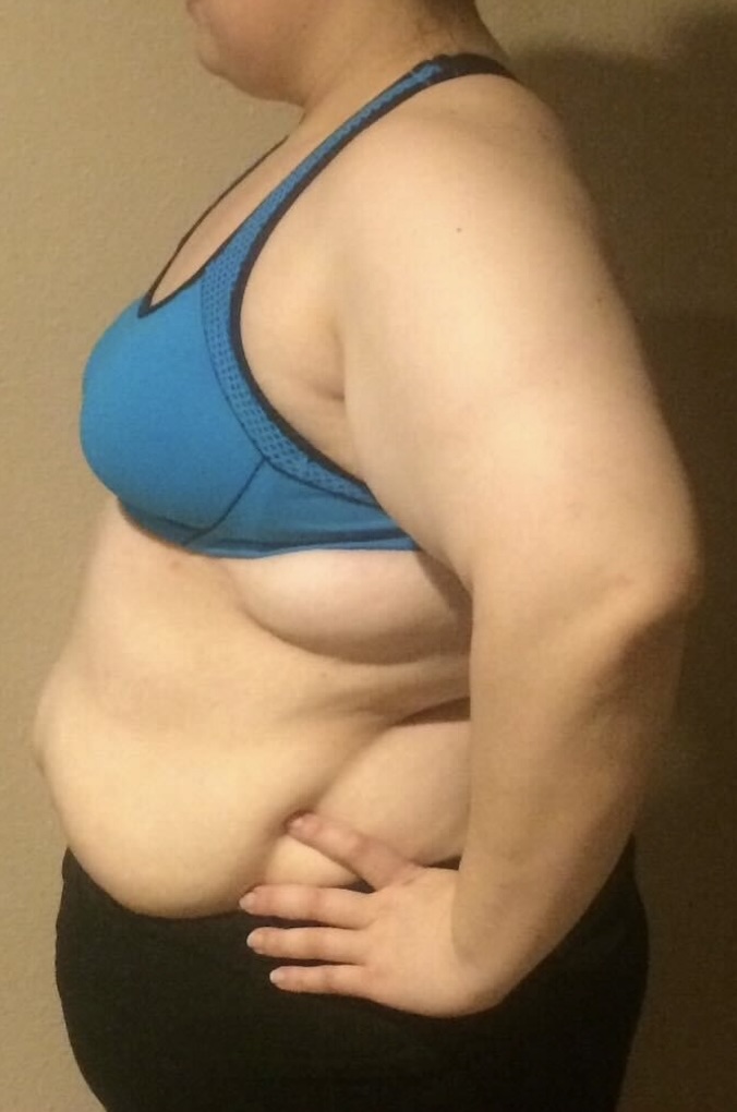 Patient Lower Body Lift Before 4