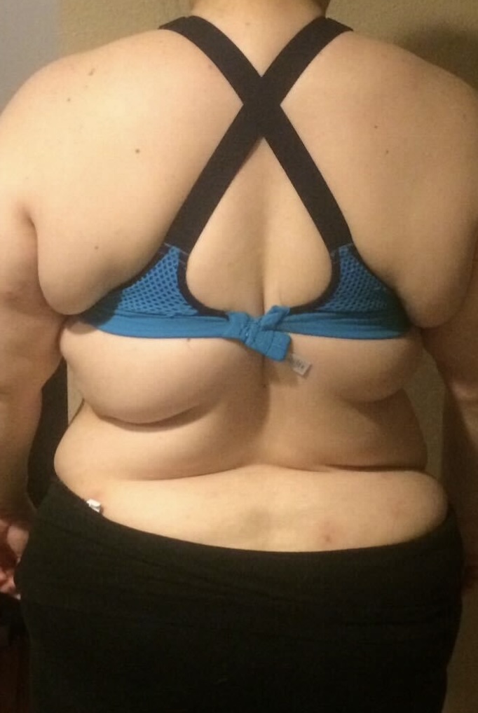 Patient Lower Body Lift Before 5