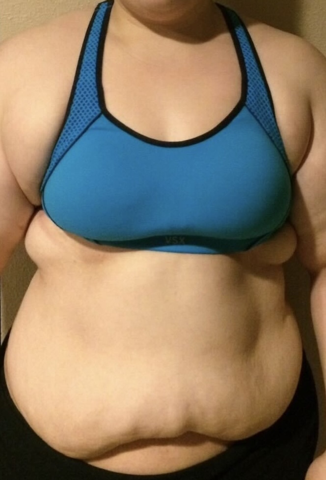 Patient Lower Body Lift Before 3