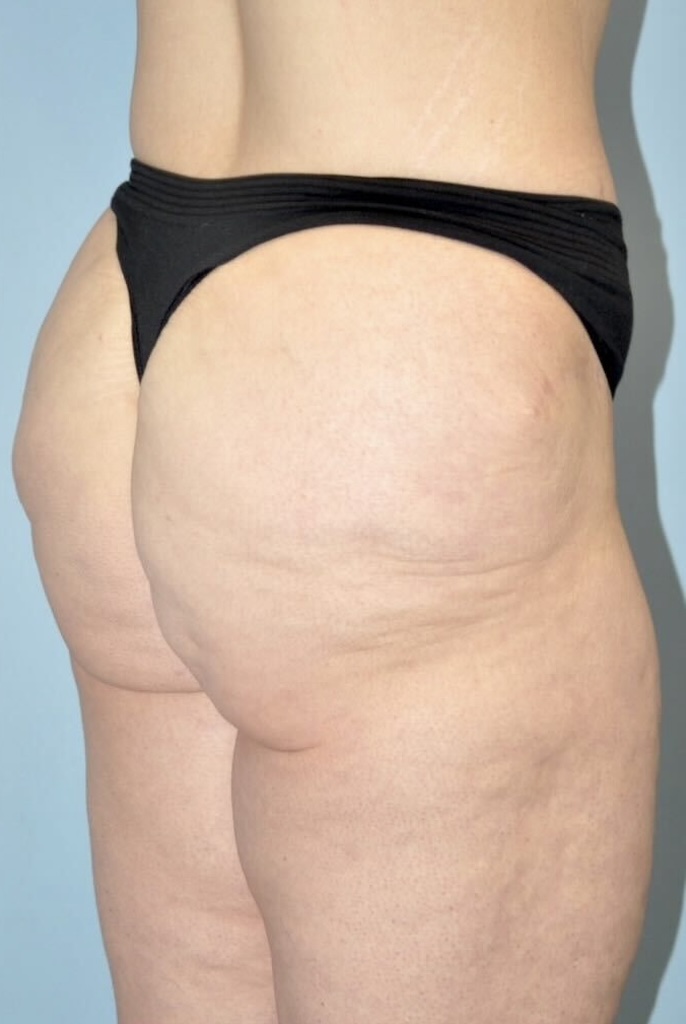 Patient Lower Body Lift Before 7