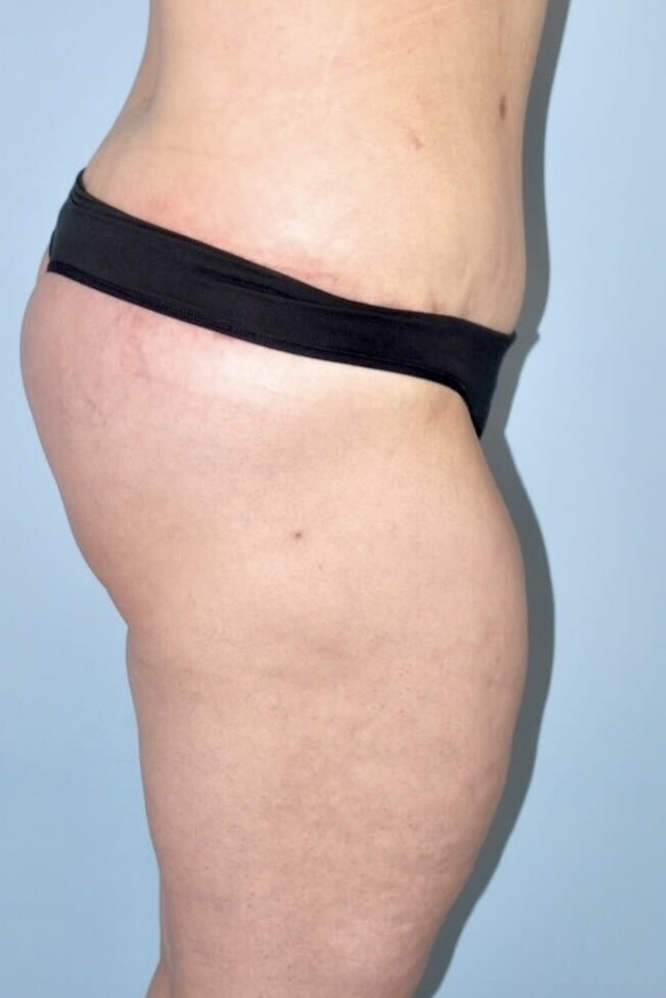 Patient Lower Body Lift Before 8