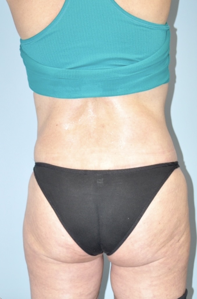 Patient Lower Body Lift Before 0