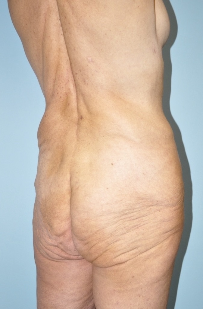 Patient Lower Body Lift Before 1
