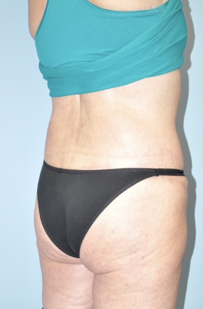 Patient Lower Body Lift Before 1