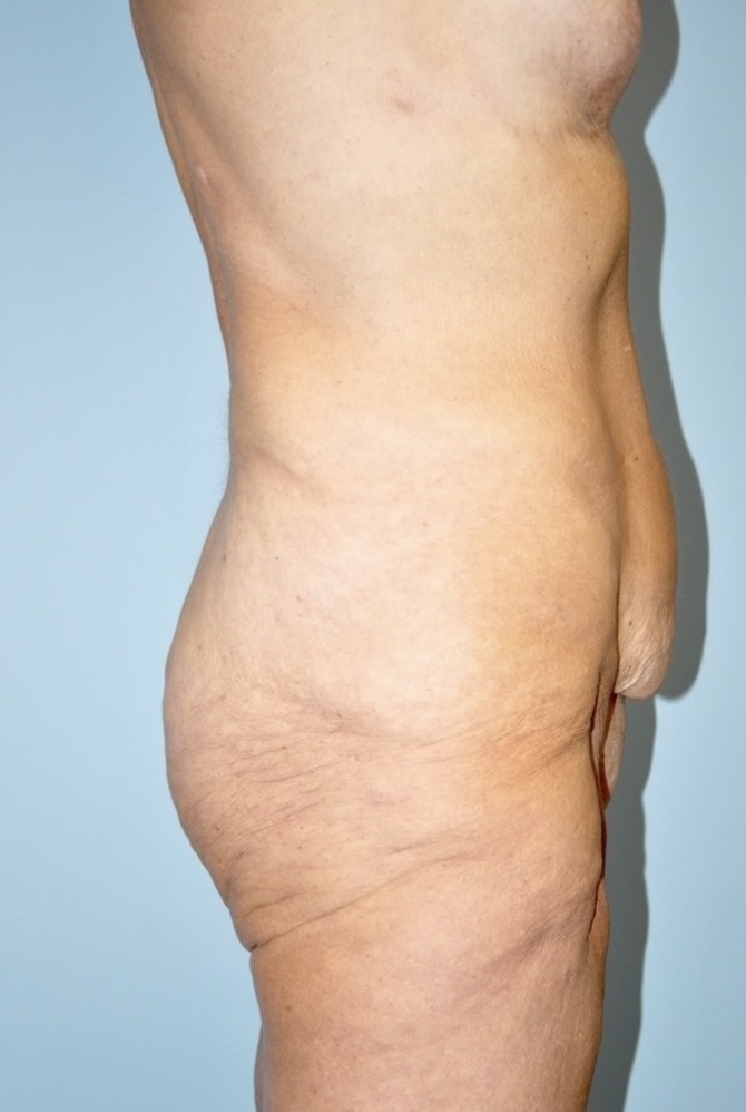 Patient Lower Body Lift Before 2