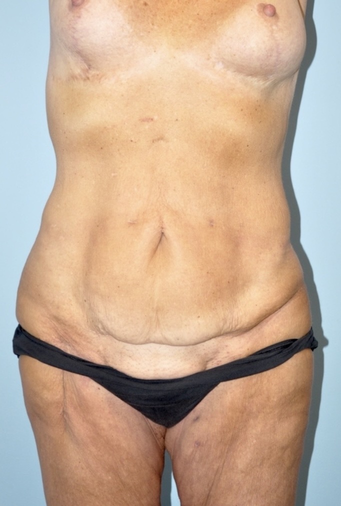 Patient Lower Body Lift Before 3