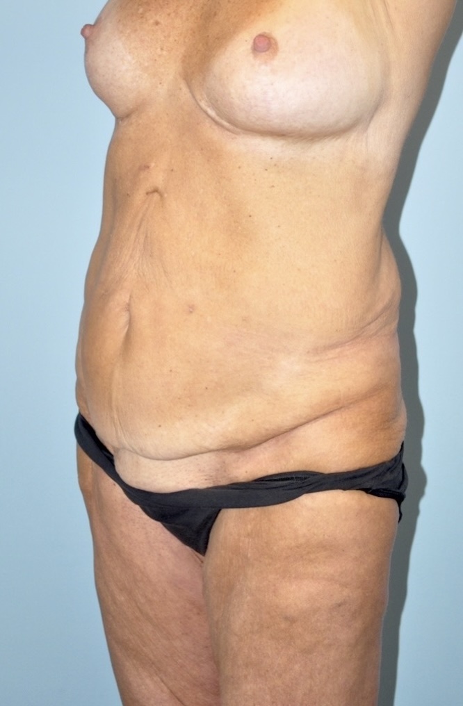 Patient Lower Body Lift Before 4