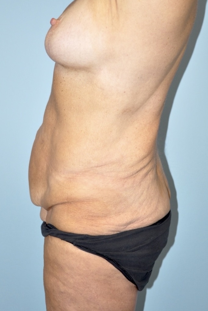 Patient Lower Body Lift Before 5