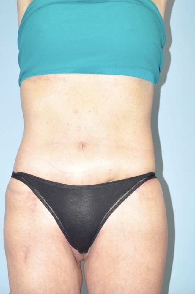 Patient Lower Body Lift Before 3