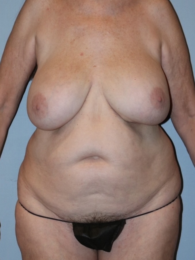 Patient Mommy Makeover Before 0