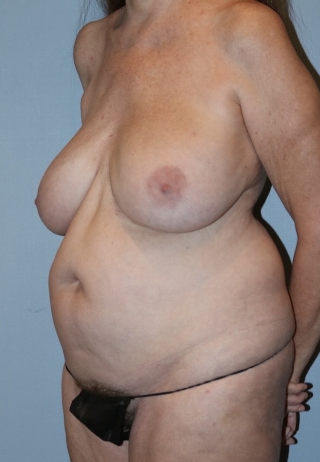 Patient Tummy Tuck Before 1