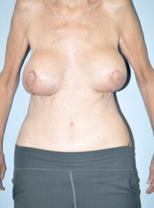 Patient Tummy Tuck After 0