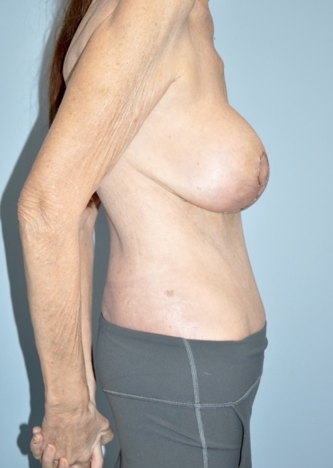 Patient Tummy Tuck Before 2