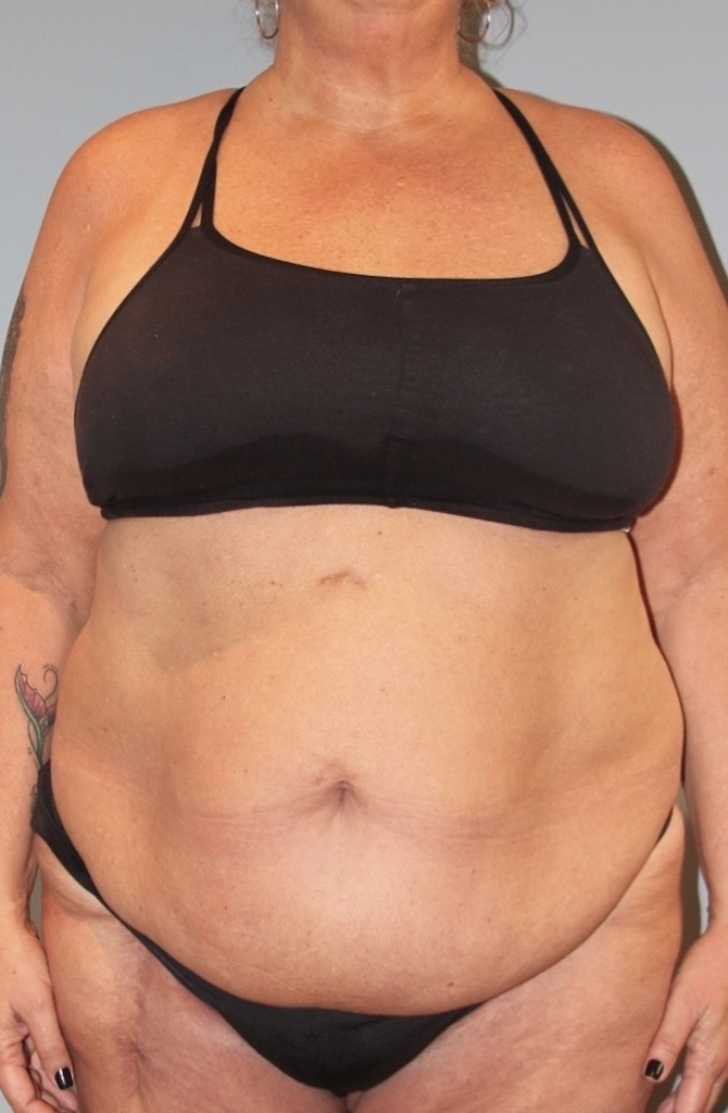 Patient Tummy Tuck Before 0