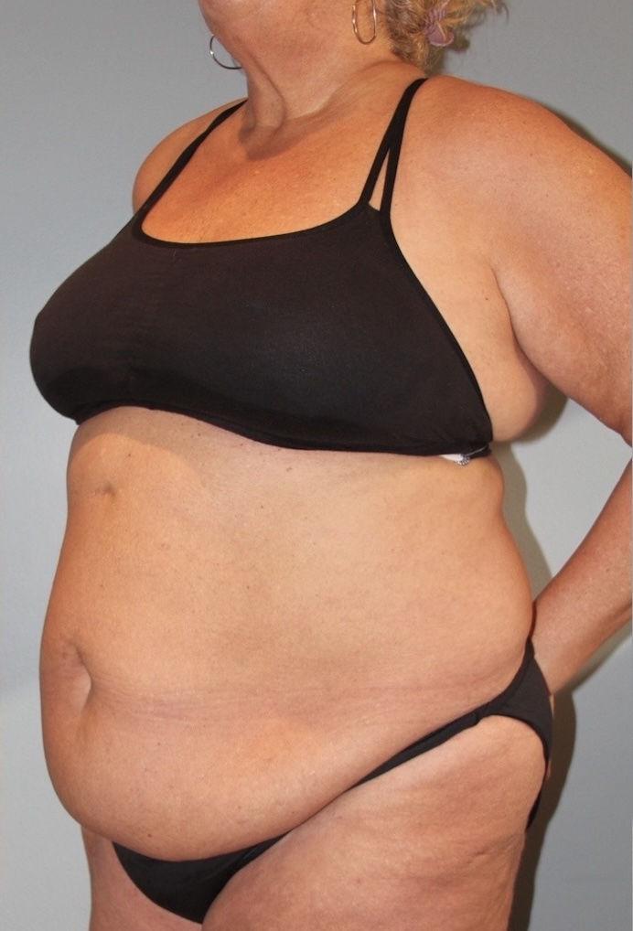 Patient Tummy Tuck Before 1