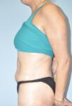 Patient Tummy Tuck Thumbnail After 2