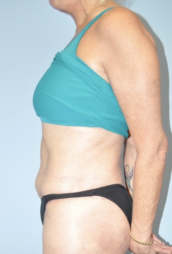 Patient Tummy Tuck Before 2