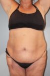 Patient Tummy Tuck Thumbnail Before 3
