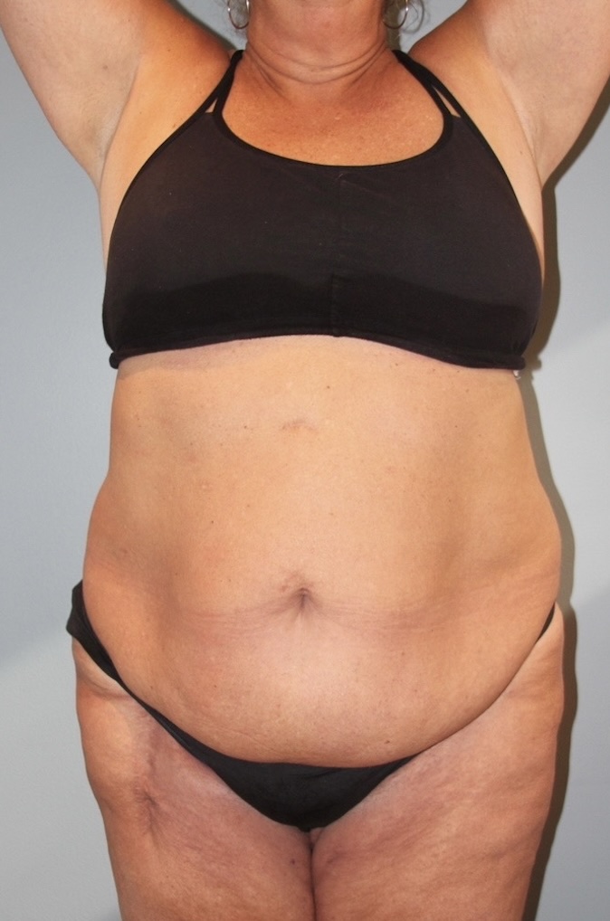 Patient Tummy Tuck Before 3