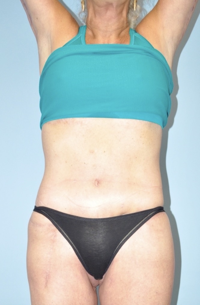 Patient Tummy Tuck Before 3