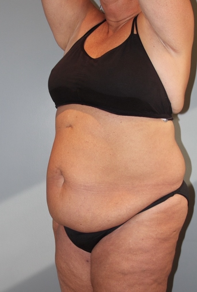 Patient Tummy Tuck Before 4