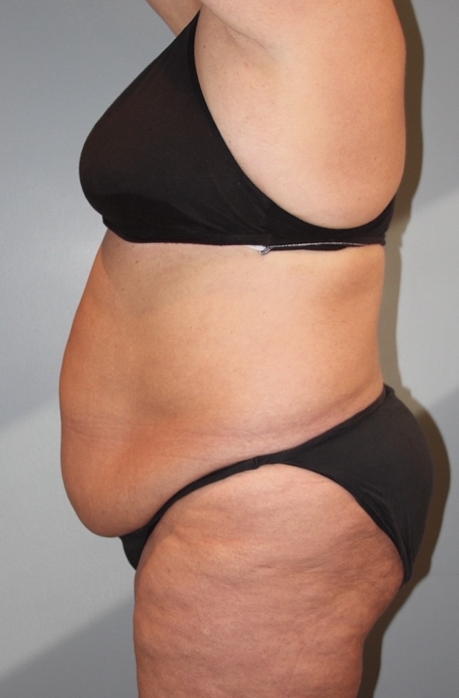 Patient Tummy Tuck Before 5