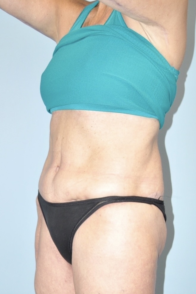 Patient Tummy Tuck Before 4