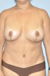 Patient Tummy Tuck Revision After 0