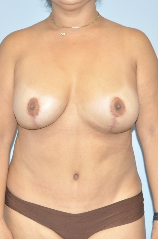 Patient Tummy Tuck Revision Before 0