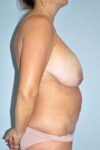 Patient Liposuction Thumbnail Before 2