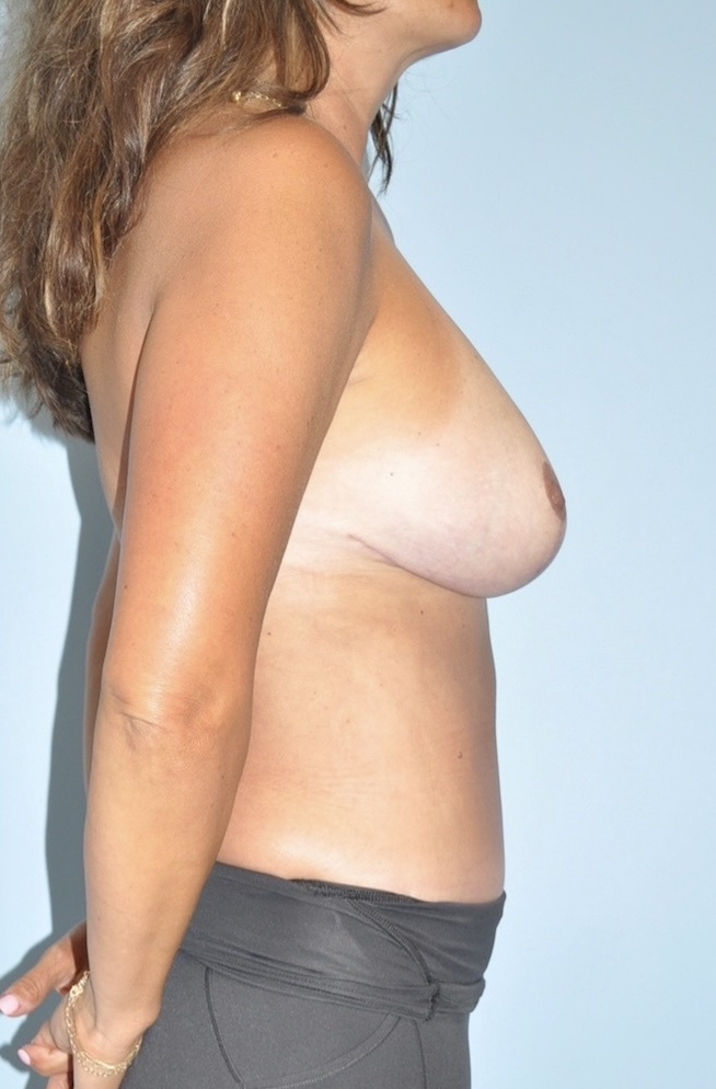 Patient Liposuction Before 2