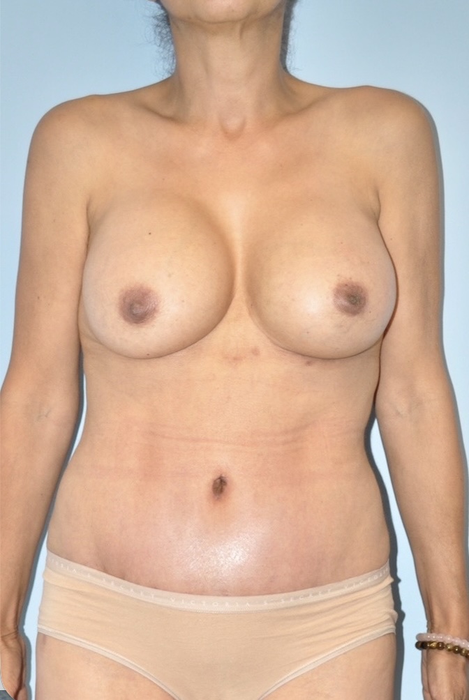 Patient Tummy Tuck Before 0